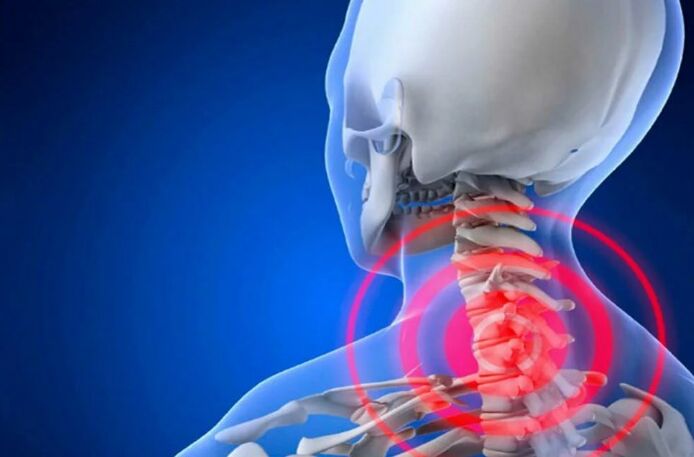 Osteocondrose da coluna cervical