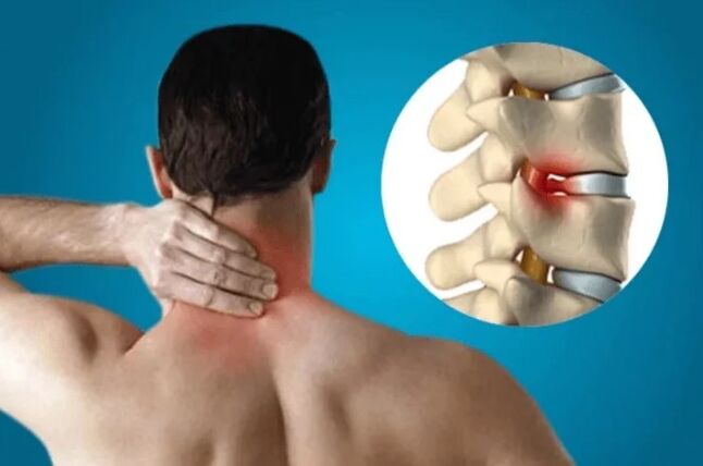Osteocondrose da coluna