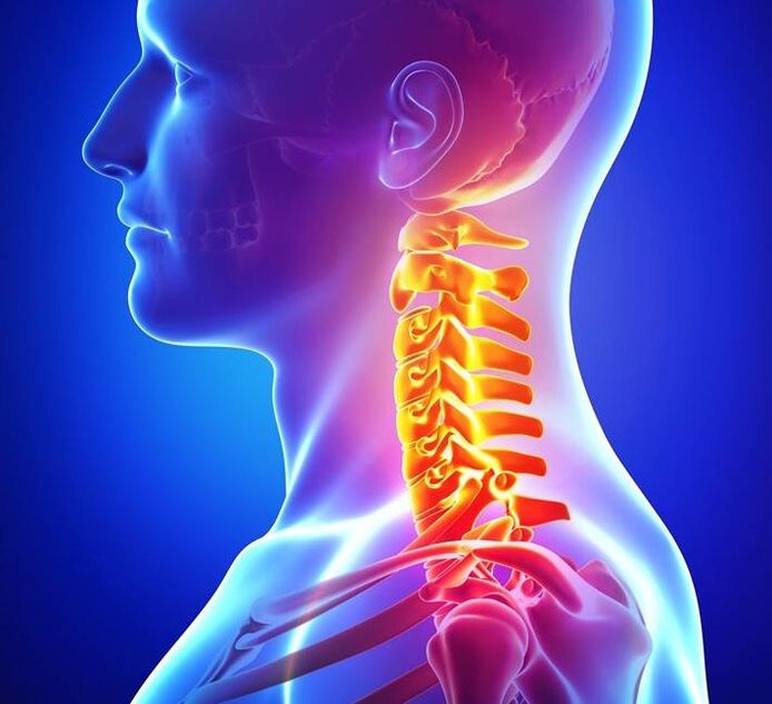 Osteocondrose da coluna cervical