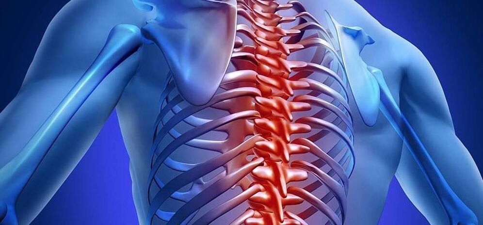 Osteocondrose da coluna torácica